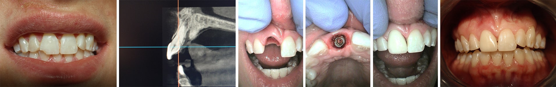 series of tooth extraction-replace