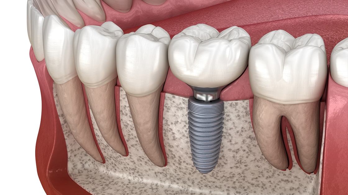 Implants Graphic